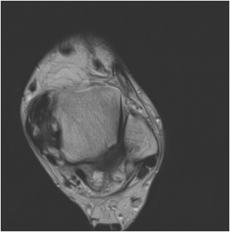 Thickned Tibialis Posterior